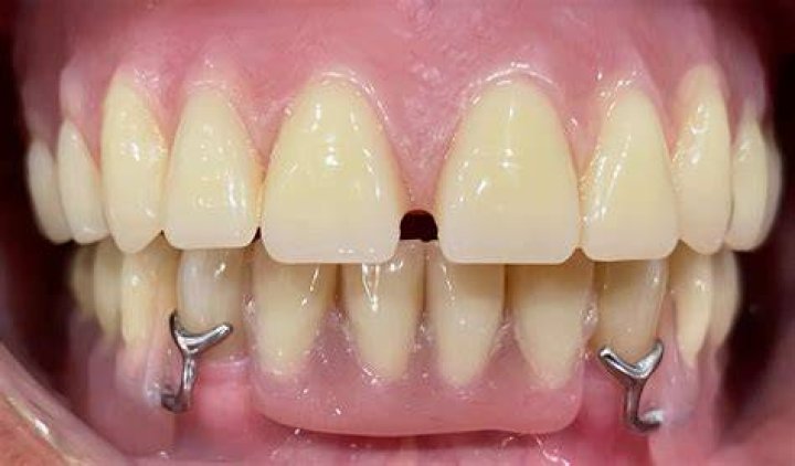 Are dentures hard to get used to?