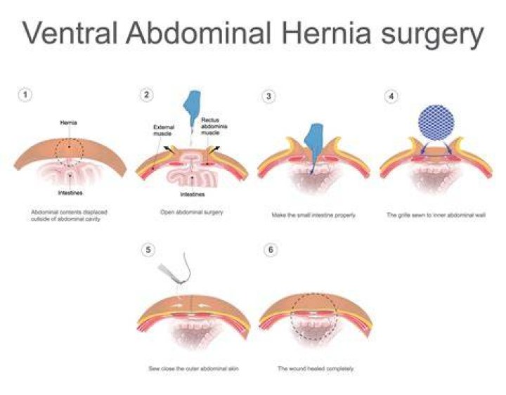 Can fat be removed during hernia repair?