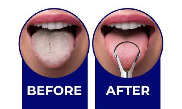 Do tongue scrapers make you gag?
