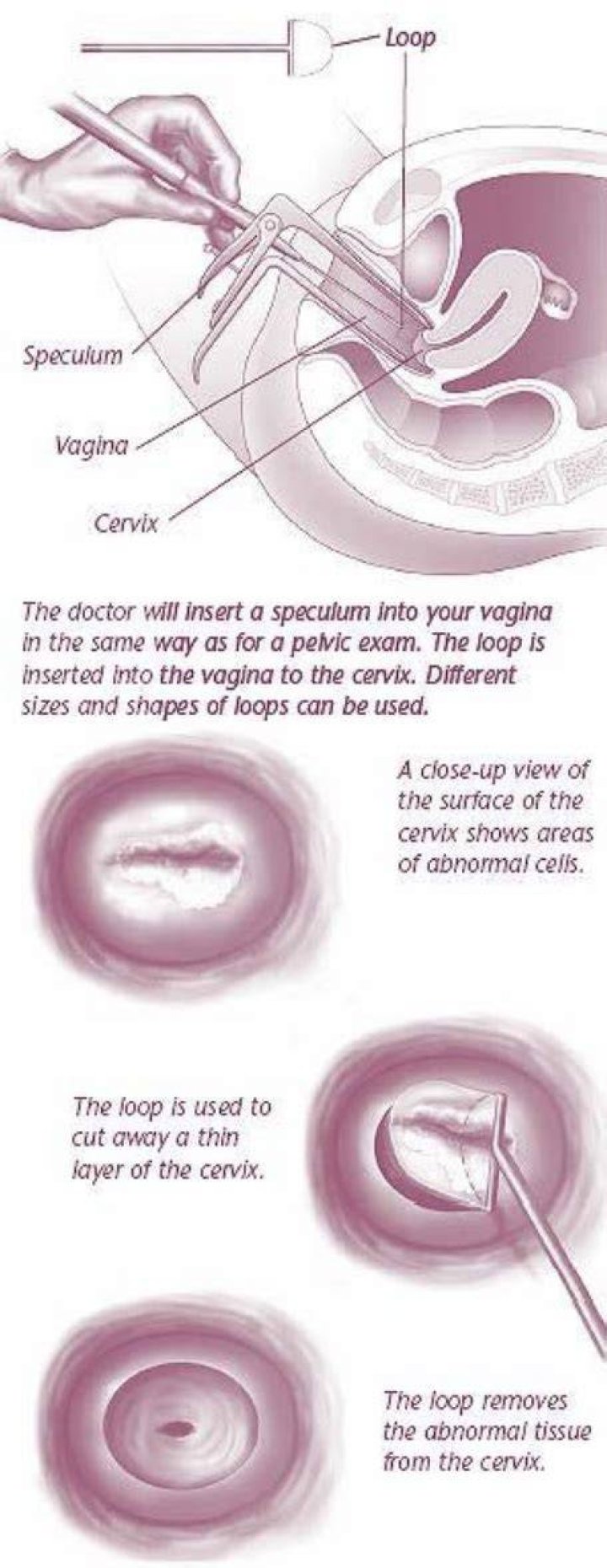 Does cervix grow back after LEEP?