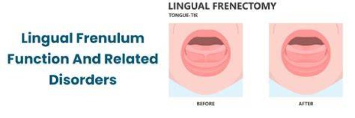 Does everyone have frenulum?