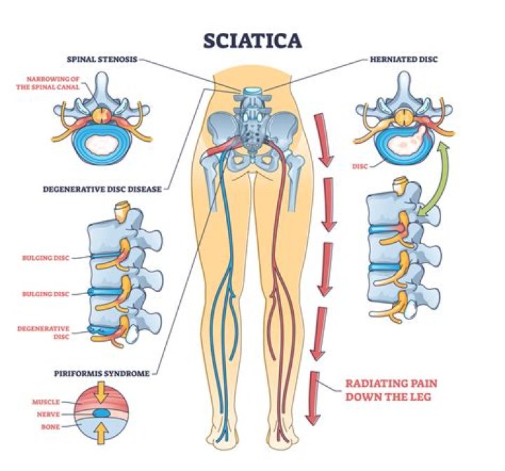 Does sciatica hurt all the time?