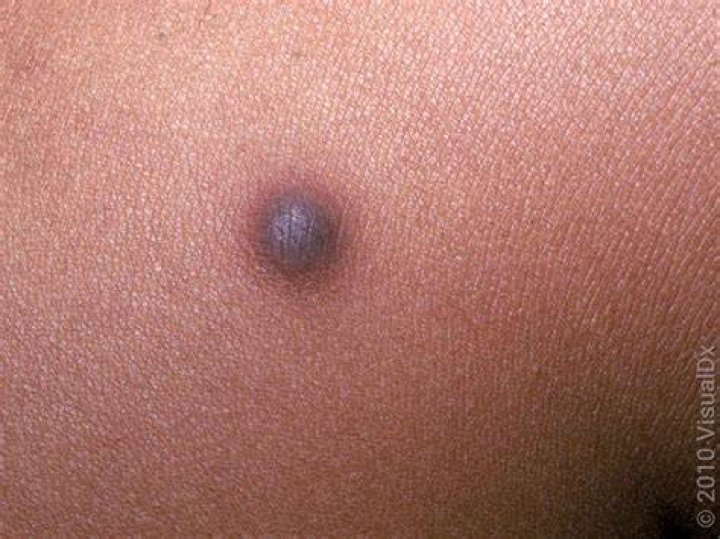 How do you prevent dermatofibroma?