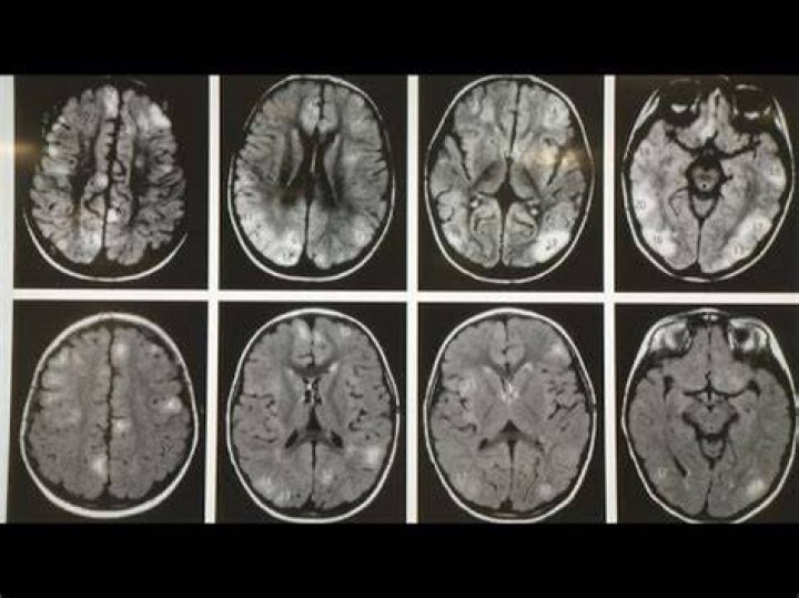 How fast can melanoma spread to the brain?