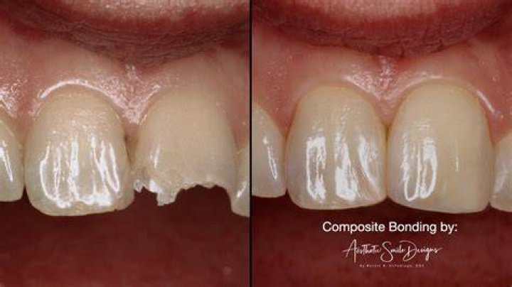 How often is composite bonding replaced?
