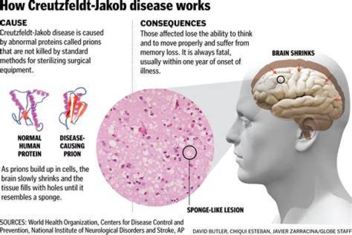 Is Creutzfeldt-Jakob disease fatal?
