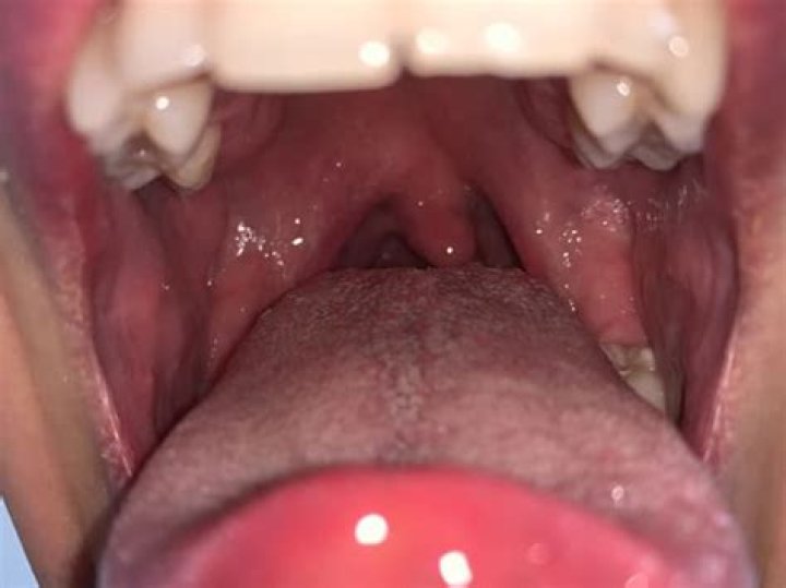What do infected tonsils look like?