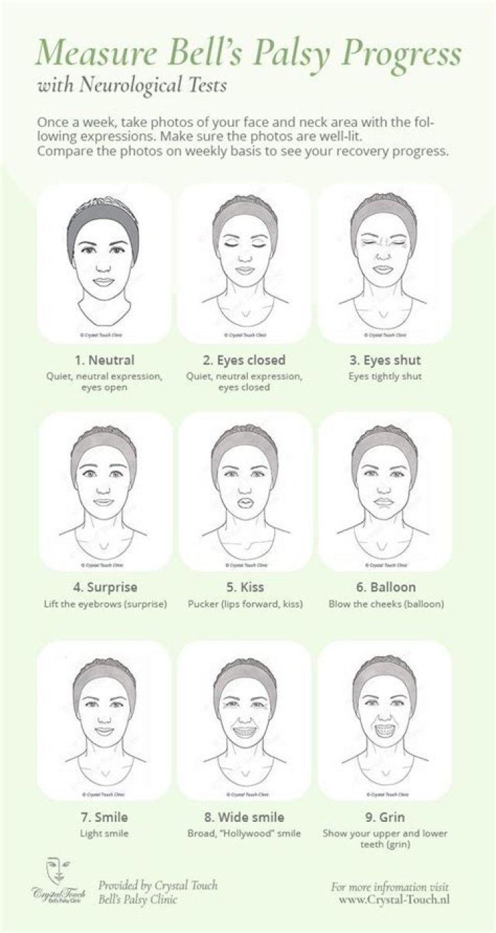 What is the normal recovery time for Bell's palsy?