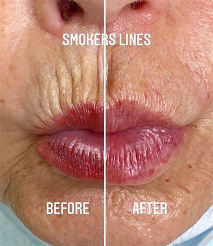 Why do I have smokers lines when I don't smoke?