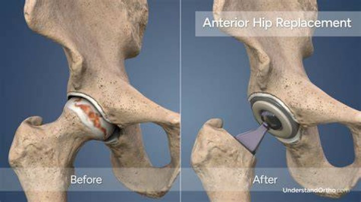 Why do I waddle after hip replacement surgery?